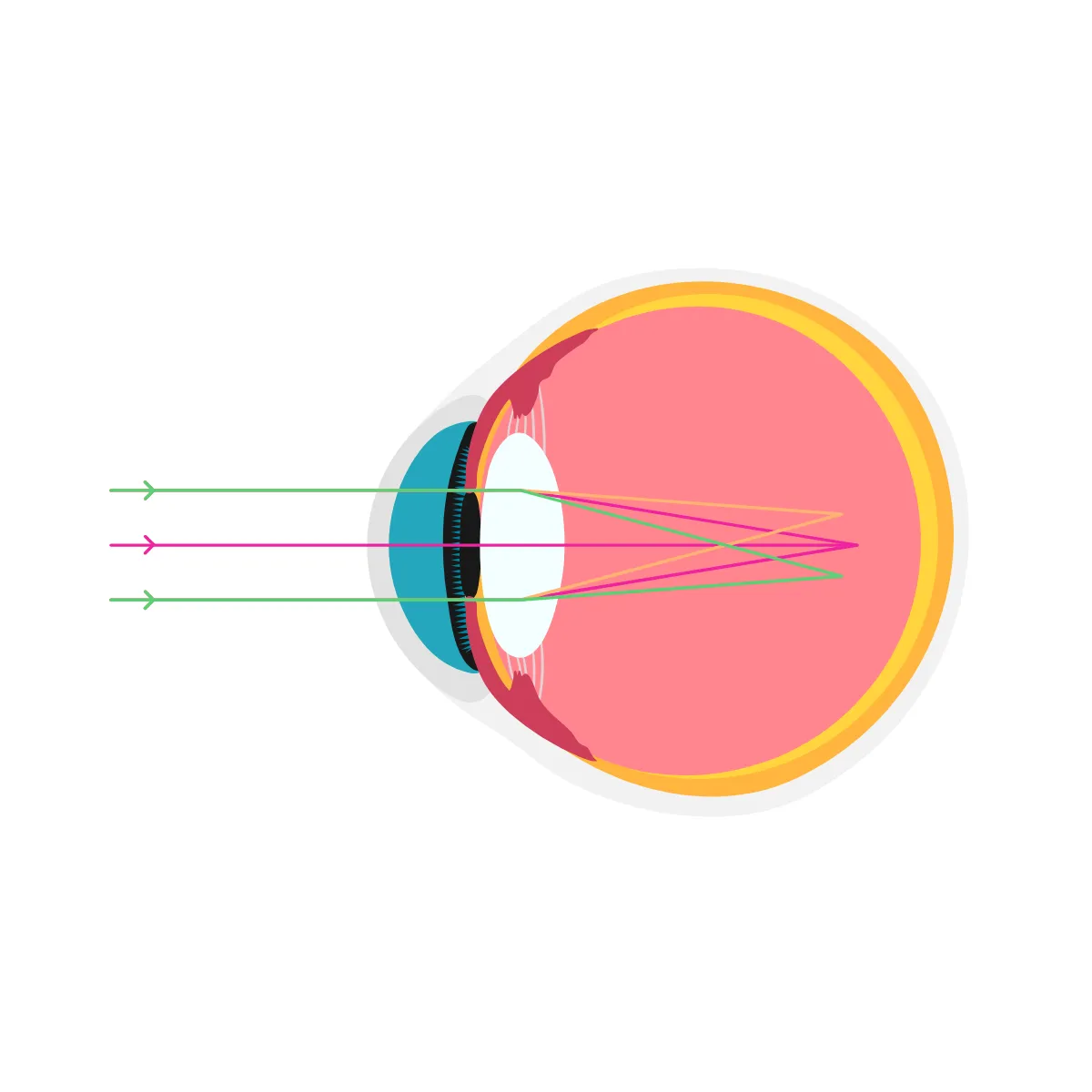 ojo con astigmatismo